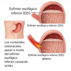 Ilustración del esfínter esofágico inferior mostrando reflujo gastroesofágico y acidez