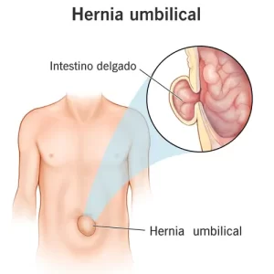 Ilustración médica de hernia umbilical en abdomen con zona abultada que requiere cirugía en Toluca y Metepec