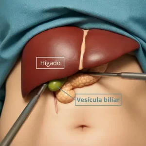 Ilustración médica de cirugía laparoscópica para extracción de vesícula biliar en Toluca y Metepec