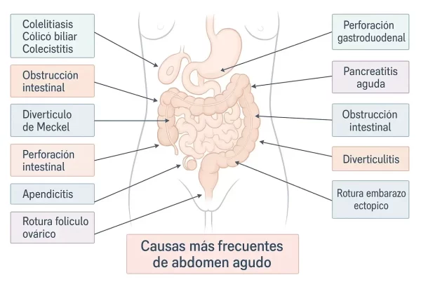Infografía de causas frecuentes de abdomen agudo como apendicitis, colecistitis, perforación intestinal y pancreatitis